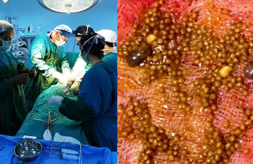 Aydın'da hastanın karnından çıkanlar şok etti! 50 adet zeytin çekirdeği ve incir...