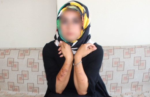 Lazer epilasyon yaptıran kadın yandı! Adıyaman'da güzellik kazası