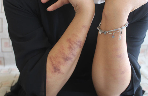 Adıyaman'da güzellik merkezinde lazer epilasyon yaptıran kadının vücudu yandı!