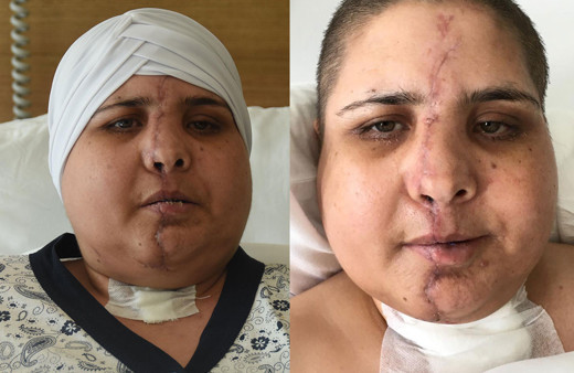 Trafik kazasında yüzü ikiye ayrıldı! 10 saatlik ameliyatla tekrar brleştirildi