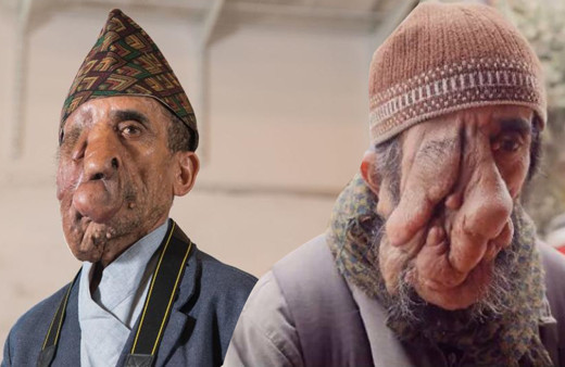 60 yıl yüzündeki 25 kilo tümör ile yaşadı 5 ameliyat geçirdi! Yıllar sonra huzura erdi