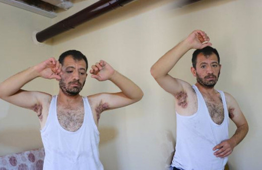 Eşim bile benden tiksiniyor dedi Niğde'de 'köpek memesi' hastası Enver'in çaresizliği!