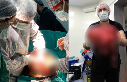 Doktor, hastanın karnından 14 kilo tümör çıkardı! Bu uyarılara kulak verin