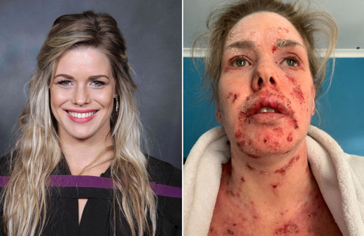 Egzama için kullandığı krem tanınmaz hale getirdi aylarca evden çıkmadı