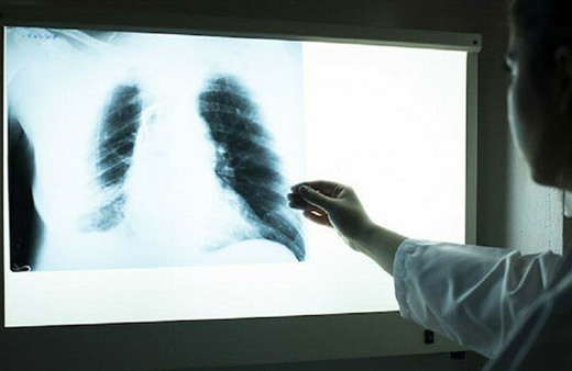 Yeni tarama yöntemiyle bulundu iyileşen Kovid-19 hastalarında 3 ay sonra ortaya çıkıyor