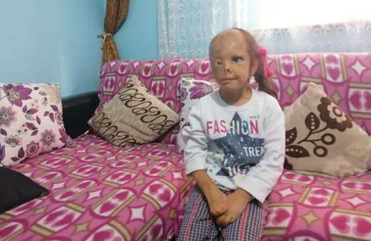 Kocaeli'de yüzü yanan minik Dilara için Sağlık Bakanlığı devreye girdi
