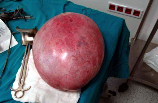 Van'da 18 yaşındaki gencin karnından çıktı! 9 kilo 800 gram ağırlığında kitle