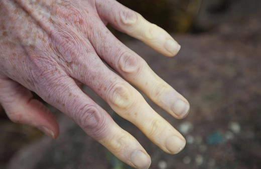 Kelebek hastalığı nedir nasıl oluşur ölümcül bir hastalık mı?