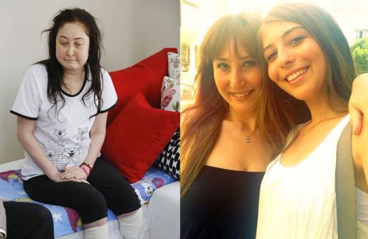 Estetik ameliyat sonrası felaket! Burun ameliyatı oldu bacakları kesildi