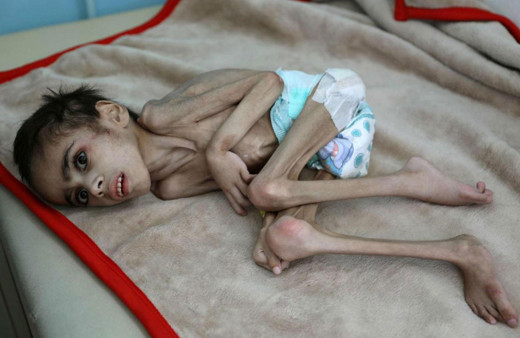 İç savaşın kucağındaki Yemen'de açlığın fotoğrafı! 7 yaşında sadece 7 kilo
