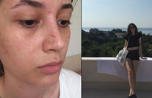 Kafaya bak! Şort giydi diye bastonla 20 yaşındaki kızın burnunu kırdı 'erkek adamım' diye savundu