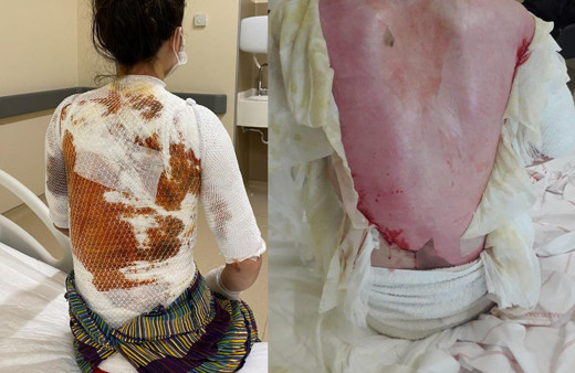 Konya'da 'koca' vahşeti! 1,5 yaşındaki kızıyla eşine kaynar su döktü serbest kaldı