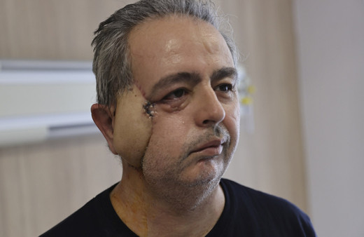 Antalya'da kanserden yüzünü kaybetti! Yapay kemik ve omzundan doku alınıp yüz yapıldı