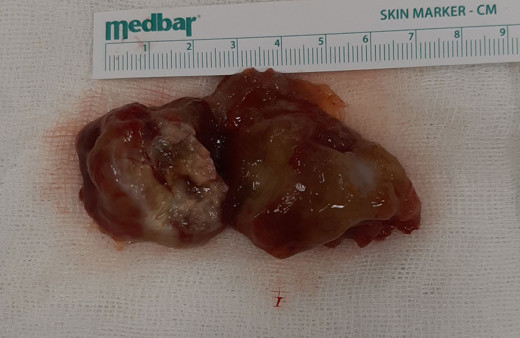 Kahramanmaraş'ta 55 yaşındaki kadının kalbinden 7 santim tümör çıkarıldı