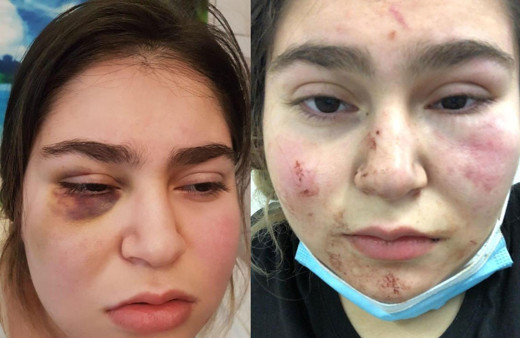 Almanya’da polisin kızıyla birlikte dövdüğü Türk konuştu: Yüzü ve saçları kanlar içindeydi