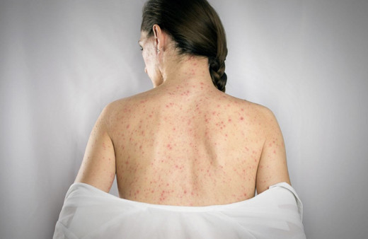 Ürtiker hastalığı nedir belirtileri neler? Ürtiker hastalığı nasıl geçer?