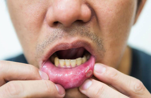 Aft ne zaman tehlikeli ağız yarası için hangi doktora gidilmeli?