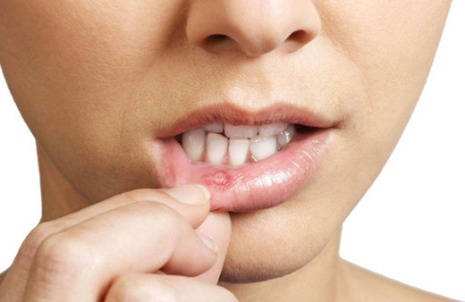 Ağızda aft neden olur nasıl geçer evde tedavisi nasıl?