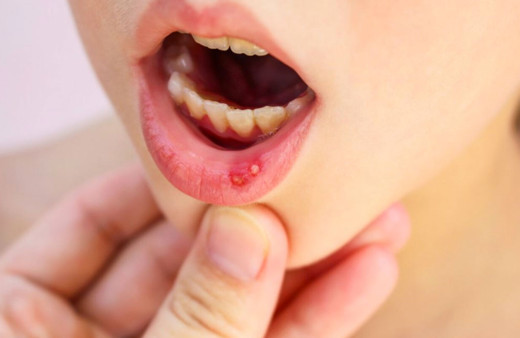 Aft nasıl geçer evde ağız yarası aft tedavisi nasıl yapılır pratik yolu