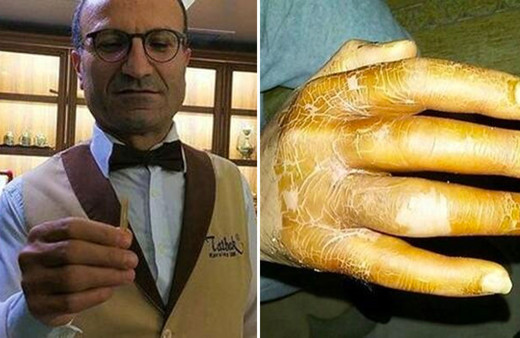 Eline kürdan battı hayatı kabusa döndü arkadaşlarımı arayıp hellalik istedim