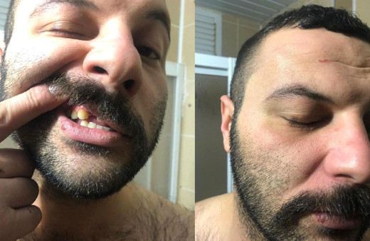 Antalya'da dezenfektan molalı polis dayağına dava