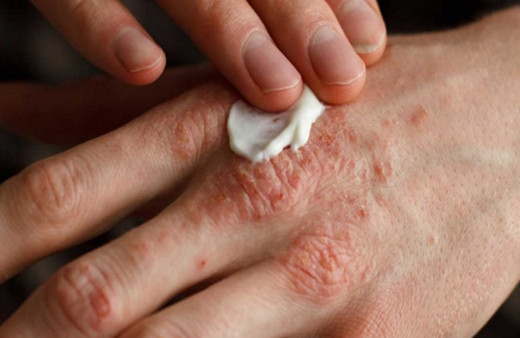 Egzamaya ne iyi gelir tedavisi nötral sabunları kullanın!