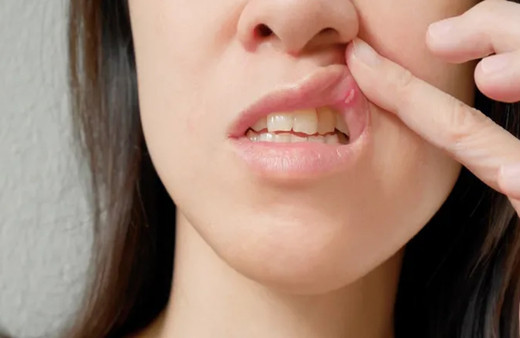 Ağızdaki aft nasıl geçer doğal yöntemler neler?