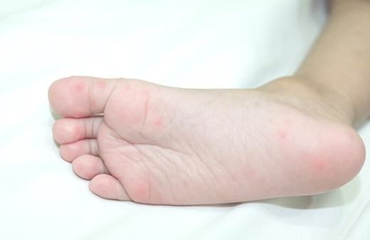 Ayağımda kırmızı lekeler var kırmızı lekeler neden olur