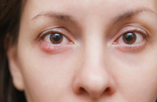 Gözdeki arpacık evde nasıl tedavi edilir?