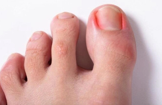 Tırnak batmasına ne iyi gelir tırnak batması tedavisi