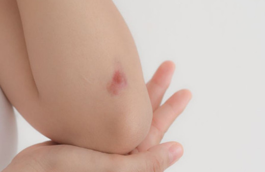 Ciltte morarma sebepleri morluklar nasıl geçer?