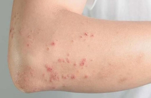 Zona belirtileri neler zonaya ne iyi gelir?