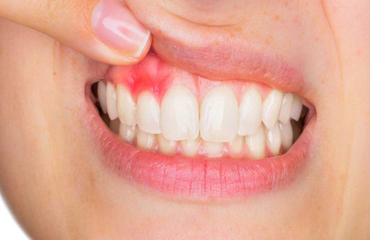 Diş eti iltihabı neden olur nasıl geçer?