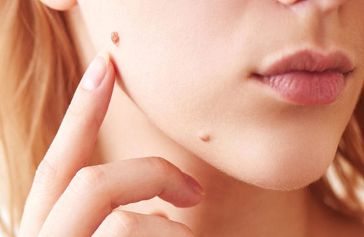 Et beni neden olur büyümesi nasıl engellenir?