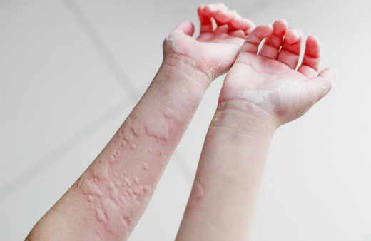 Ürtiker bahar aylarında daha sık görülüyor!