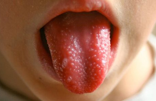 Dilde kabarcıklar neden olur? Nasıl geçer?