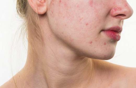 Sivilce nasıl geçer? Sivilcelerinizden kurtulmanın yolu bitkilerde saklı!