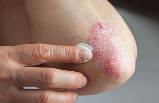 Strese bağlı egzama nasıl geçer tedavisi