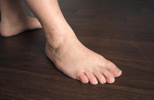 Ayakkabı ayağınıza olmuyorsa dikkat! 5 kişiden 1’inde görülüyor: Kısırlığa neden oluyor