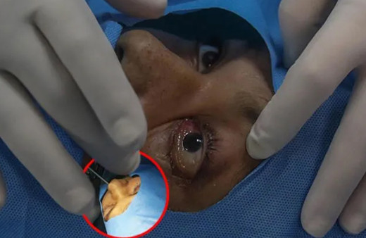 Görüntüler tüyler ürpertti! İşte kara mantar ameliyatı: Gözler böyle oyuluyor