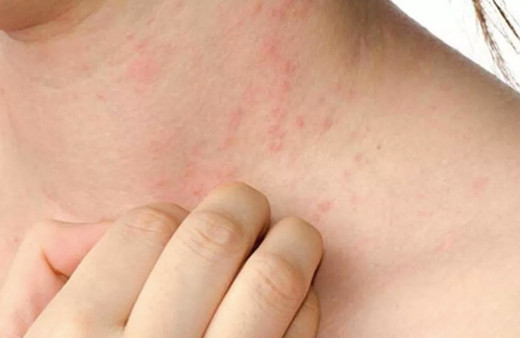 Soğuk havalar deri hastalıklarını tetikliyor