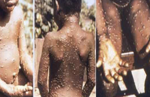 Koronavirüs sonrası şimdi de maymun çiçeği virüsü paniği