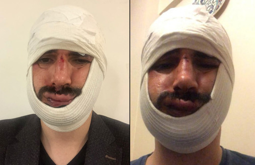 Anadolu Ajansı muhabiri dehşeti yaşadı! Yüzüne onlarca dikiş atıldı