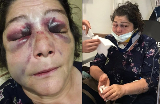 Giresun'da CHP'li başkana o sözleri söyleyince kadını bu hale getirdiler! Başkanın savunması pes dedirtti