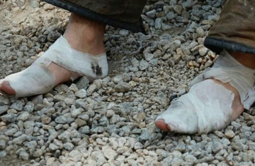 Ayakları sargı içinde olan itfaiye eri yangın bölgesinden ayrılmadı