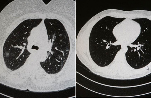 Aşılı ve aşısız olarak koronaya yakalanan 2 gencin akciğer tomografisi arasındaki fark görüntülendi