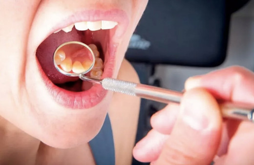 Damak yarası neden olur nasıl geçer bu yöntemleri deneyin