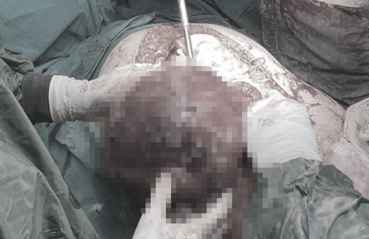 Kusma şikayetiyle hastaneye gitti karnından çıkarıldı doktor çok nadir görülen bir vaka dedi