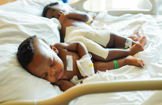 Kamerun'da dünyaya gelen yapışık siyam ikizleri Türkiye'de şifa buldu