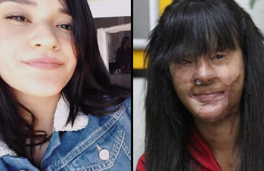 Berfin Özek yüzüne asit atan eski erkek arkadaşıyla evlendi